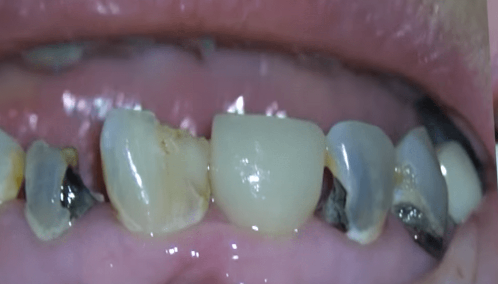 What Does Dental Caries Mean