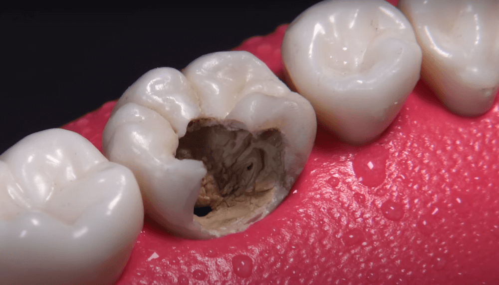 What Does Dental Caries Mean